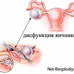 Дисфункция яичников