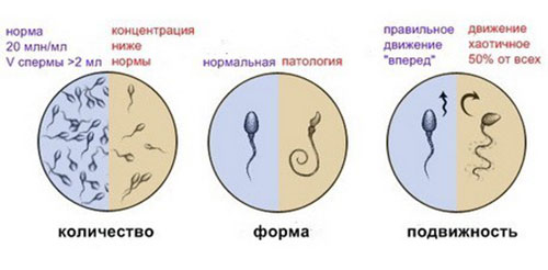 Неподвижность сперматозоидов