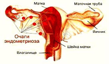 Внутренний эндометриоз матки
